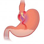 Doença do Refluxo Gastro-Esofágico