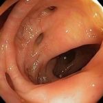 Diverticulose cólica